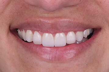 After smile makeover