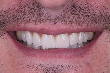 After smile makeover