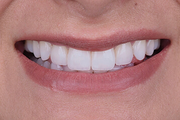 After smile makeover