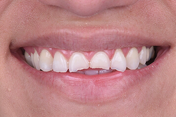 Before smile makeover