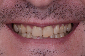 Before smile makeover