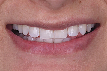 Before smile makeover